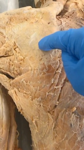 Institute of Human Anatomy | Check out this Genetic Variability in one of our cadavers 🤔 #body #science #anatomy | Instagram