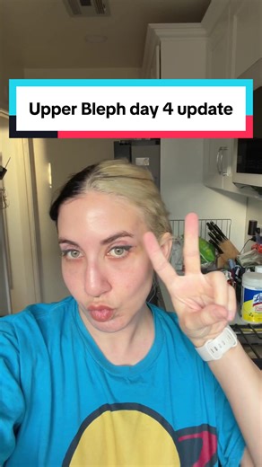 Upper Blepharoplasty Day 4: Recovery Update