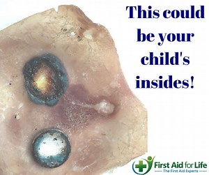 Know the dangers of button batteries