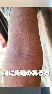 アトピーで夏場に長袖を来て隠していた私が言うのもなんですが・・・・【自然治癒力向上くらぶれのあ】 #アトピー改善 #体質改善