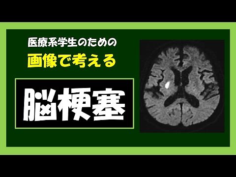 【医療系国家試験】脳梗塞