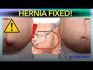 Inguinal Hernia Surgery: How Surgeons Repair a Hernia