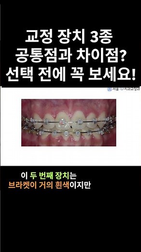 "효과는 똑같다! 다른 건 색 뿐?"#서울D교정치과#서울대전문의
