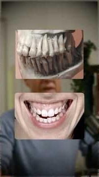 Maxilla vs Alveolar Bone: Why Adults Still See Change