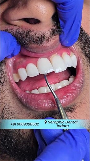 Watch This Satisfying Veneer Procedure #veneers_smile