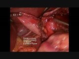 Laparoscopic Nissen Fundoplication  • Video • MEDtube.net
