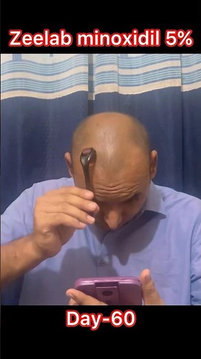 Zeelab minoxidil 5% review #zeelab #haircare