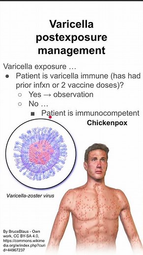 Varicella postexposure management