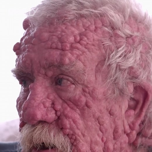 Dr Lee helps Diane with her condition, neurofibromatosis, a disease that covers her body with painful bumps 🤩 #DrPimplePopper | Really Channel