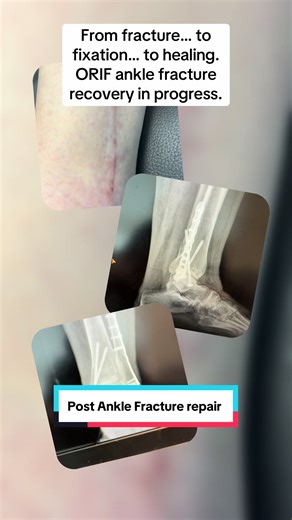 A broken ankle is more than just one bad moment. It is the surgery, the recovery, the swelling, the scar care, and the gradual return to walking with confidence. This is a look at ankle fracture healing after ORIF (open reduction internal fixation). #orif #anklefracture #surgerytiktok #surgery #surgerytok