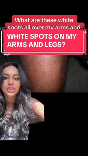 Understanding White Spots on Arms and Legs
