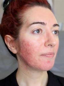 666K views · 148 reactions | "I love the mask, it reduced all my acne and its healing the scars as well! Now I feel like I can finally walk out without makeup!" - Angela, Indianapolis Get yours today ▶ www.sandandsky.com | Sand & Sky | Facebook