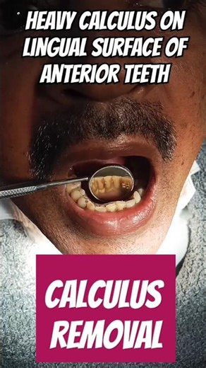 Calculus removal from teeth#dental #youtubeshorts #teethcleaning #dentistry #calculus #scaling #reel