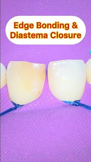 Composite Edge Bonding & Diastema Closure Under Rubber Dam 🦷✨