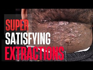 MOST SATISFYING EXTRACTIONs EVER