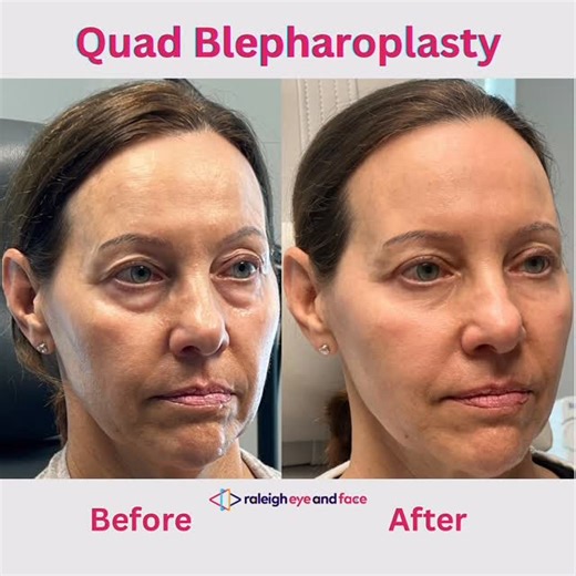 Pradeep Mettu, MD on Instagram: "Quad blepharoplasty before and after 👀✨ This is upper and lower eyelid surgery performed together to restore a more rested, refreshed, and natural appearance—without changing who you are. Notice how the eyes look brighter, smoother, and less tired, while the face still looks completely like her. That’s the goal of modern cosmetic eyelid surgery: subtle, precise, and undetectable results. Many patients worry that quad blepharoplasty will make them look “done” or 