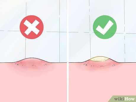 Effective and Safe Techniques to Relieve a Painful Zit Without Causing Damage - Smart.DHgate – Trusted Buying Guides for Global Shoppers