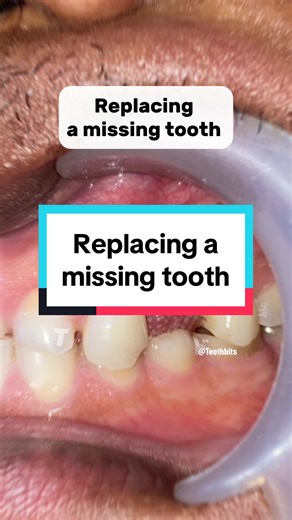 Replacing a Missing Tooth with a Dental Bridge