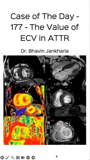 Case of the Day - 177 - The Value of ECV in ATTR