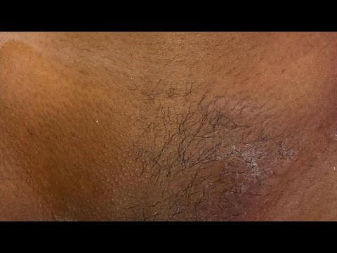 How to lighten dark bikini line| Bleaching intimate parts|DIY Vagacial|￼Get rid of discoloration