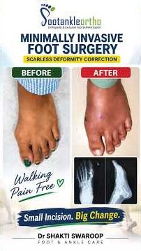 Scarless Foot Surgery | Minimally Invasive Big Toe Deformity Correction | Pain-Free Walking