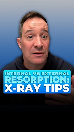 Internal or external resorption can be tricky to tell. Remember THIS: If the lesion shifts, it’s external. If it stays centered, balloon-like? That’s internal. WANT TO LEARN MORE? Comment ENDO and I'll send you @drbrettgilbert Access Endo FREE training! #dentist #newdentist #endo #endodontist #endotraining #accessendo #dentalpracticemastery #dentalirrigation #endodontics #endodoc #rootcanal #rootcanaltreatment #dentalcare #toothsaving #treatmentplanning | Dr. Rinesh Ganatra