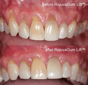 New Receding Gum Treatment Comes To Los Angeles: Uses Healing Power Of Patient’s Blood