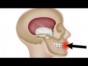 Temporalis Muscle - Trigger Point Anatomy