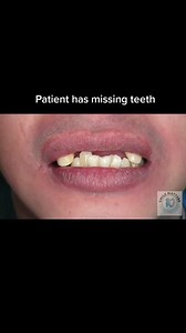 Transform Your Smile with Flexible Dentures | Before & After Photos