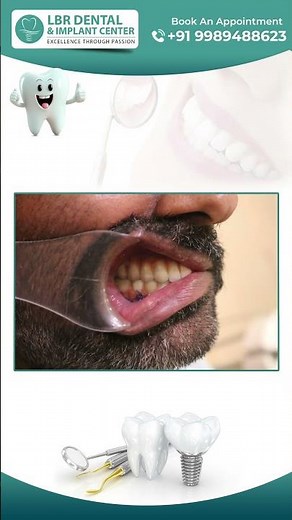 Transform Your Smile with Full Mouth Rehab at LBR Dental – Best Dental Hospital in Hyderabad!