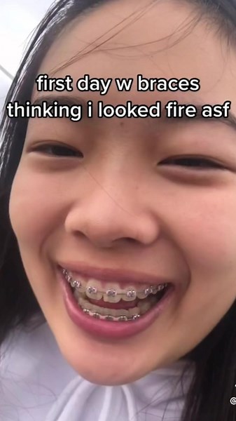 Who else was so excited on Day one? 😂👇 #braces #bracesgirl #braceson #bracesoncheck #bracescheck #bracescloseup #bracescolors #bracesmemes #bracesmeme #bracestok #zahnspangenmemes #zahnspangenmeme #zahnspangengirl #zahnspange #zahnspangen #zahnspangentipps #foryou #viral #fyp