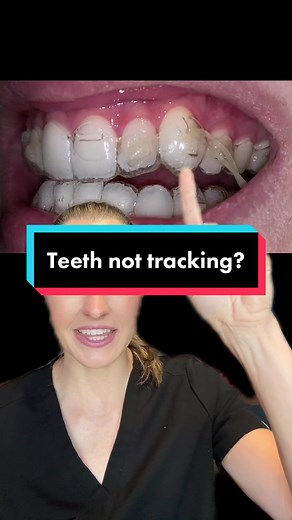 #greenscreen What should you do if your Invisalign trays aren’t fitting and teeth aren’t tracking? Try using a chewy, wear your trays longer, or have your orthodontist take a new scan to get new trays that are fitting properly. #drwindhorst #choiceorthodontics #invisalign #invisaligntips #clearaligners #fyp #learnontiktok #tracking #airgap #orthodontics #orthodontist #orthodontistsoftiktok