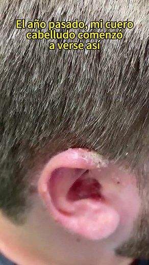 Itchy and red scalp, with small, persistent pimples. Try this selenium disulfide shampoo!#scalpacne #hairoil #antidandruff #dandruff