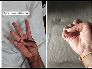 Tendon transfer - Opponensplasty