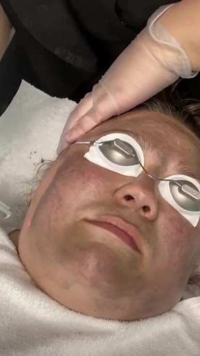 Hollywood Laser Carbon Peeling Treatment Explained