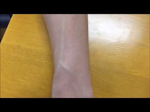 ルート確保のコツ（末梢静脈路確保の手順）Insert IV catheter