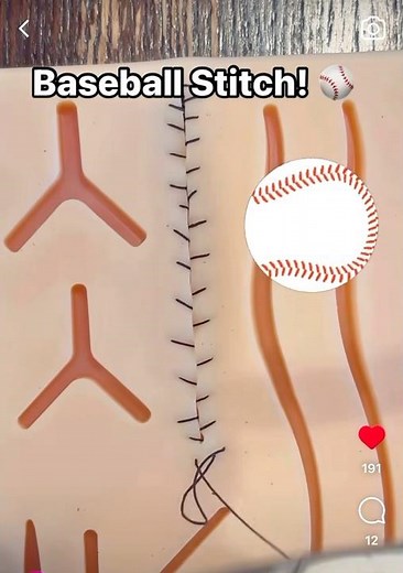 Baseball stitch! #suture #surgeon #myomectomy #obgyn