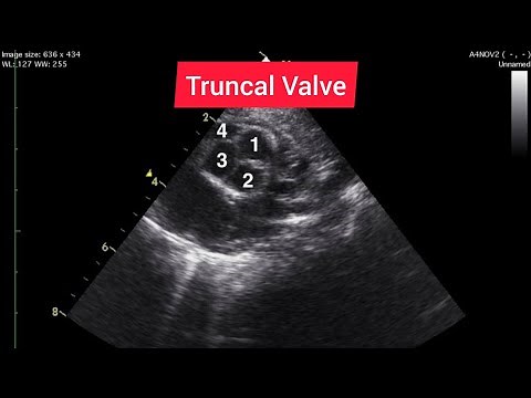 Truncus Arteriosus Echocardiography Compilation