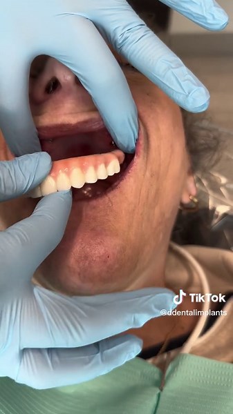 Zygomatic Implants in Charlotte: Your Ultimate Dental Solution