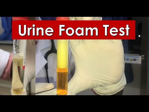 Urine Foam Test | Bile In Urine | Foamy Urine | Mediracewars