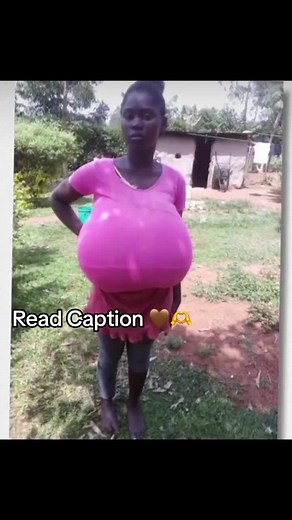 Sponsorship for Needy Girls with Gigantomastia in Kenya