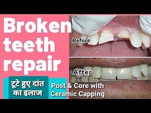 Broken teeth repair | Front teeth ceramic capping | टूटे हुए दांत का इलाज | Post & Core build up.