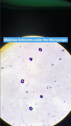 Schizont stage of Plasmodium malariae under microscope — observe the beautiful stages #PathoScopeLab