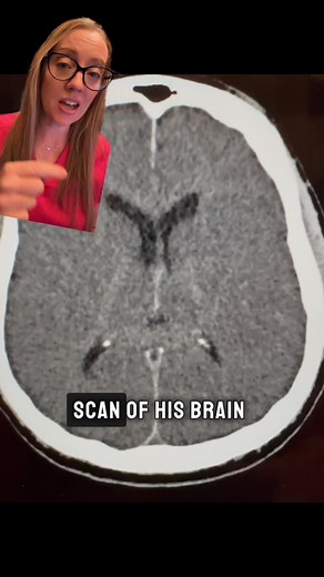 Case study 132 - Anoxic Brain Injury Anoxic brain injuries are caused by a complete lack of oxygen to the brain, which results in the death of brain cells after approximately four minutes of oxygen deprivation. The overall life expectancy for patients with anoxic brain injuries or hypoxic brain injuries can vary based on the severity of the brain damage from lack of oxygen and is something that should be discussed with a patient’s physician. If you don’t know CPR, please consider taking a class