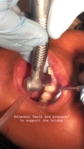 Learn How Dental Bridges Can Permanently Replace Missing Teeth
