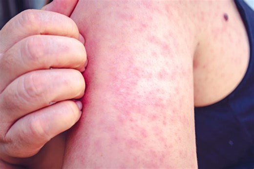 Measles outbreak reported in Franklin County