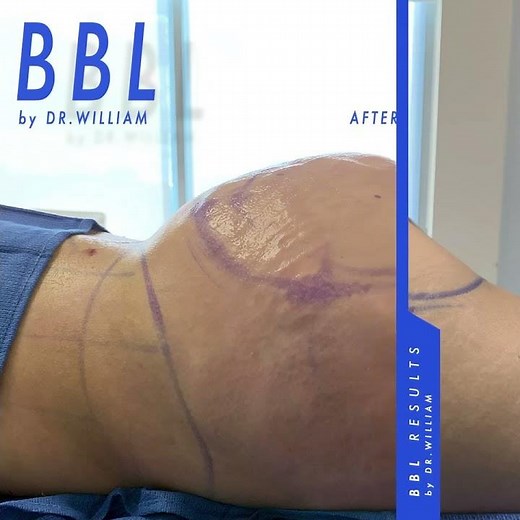 BBL - Before & After - Dr. William #shorts