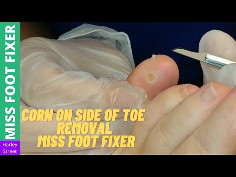 Corn on side of toe removal | Miss Foot Fixer