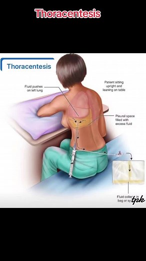 What is Thoracentesis? Procedure and Benefits Explained