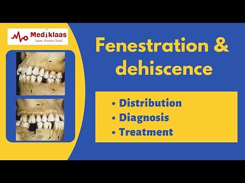 Fenestration and Dehiscence l Periodontal anatomy l Mediklaas